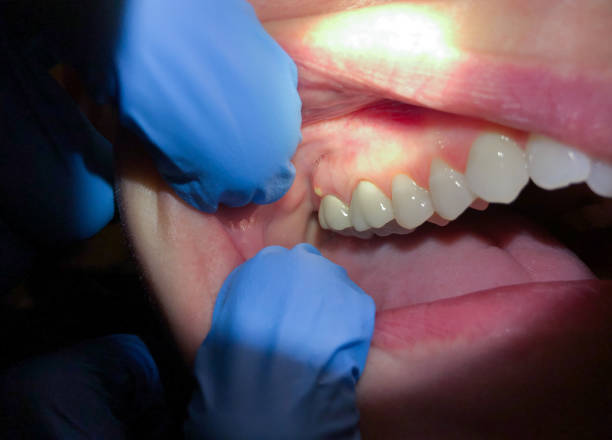 Best Chipped Tooth Repair Near Me  in Texas City, TX